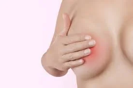 Sore Nipple Management and Treatment