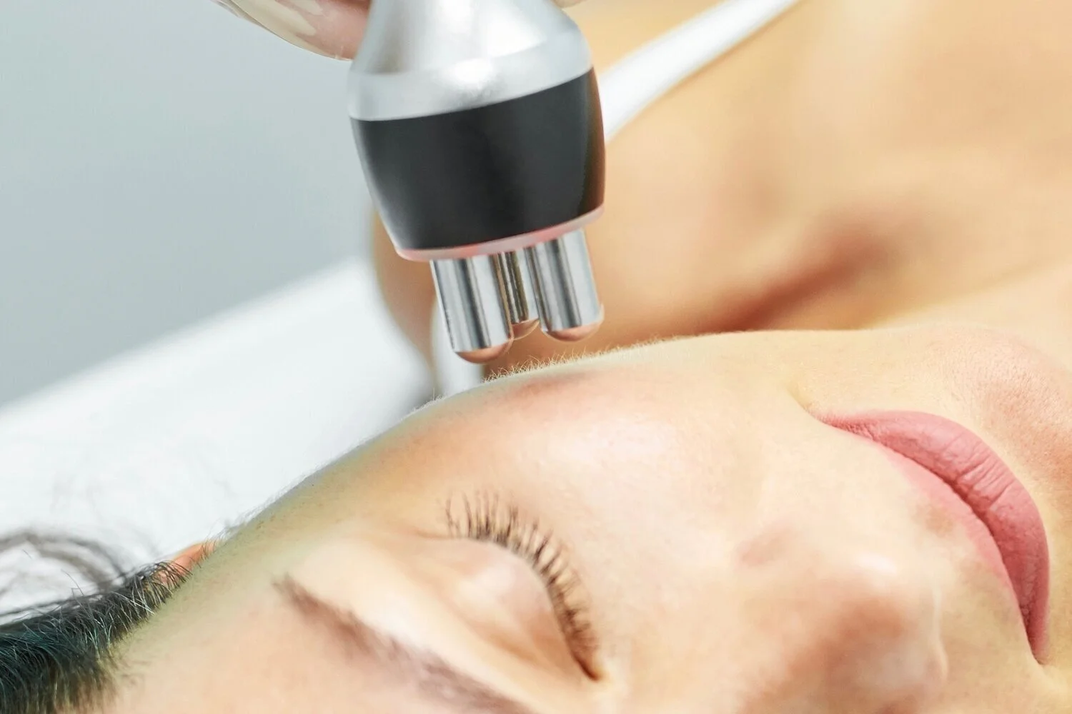 Radio Frequency (RF)-based Skin Tightening
