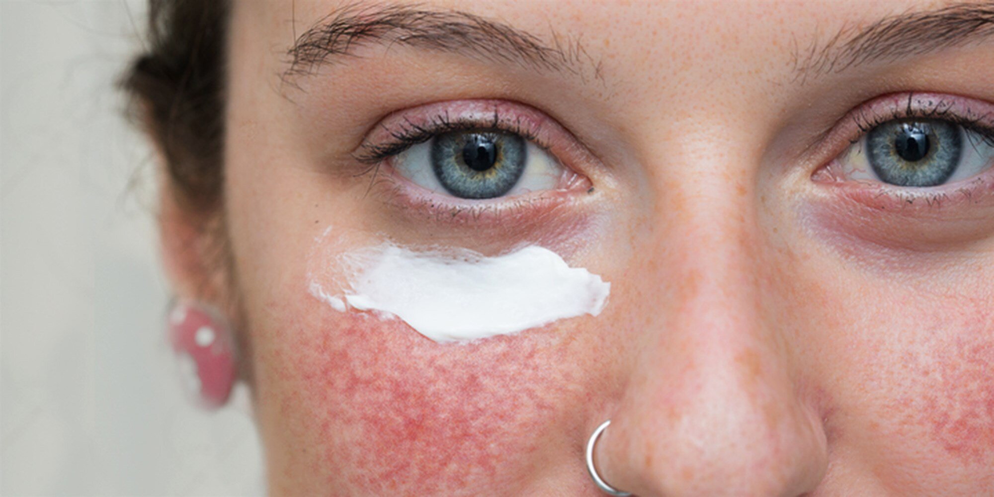Differentiating rosacea from sensitive skin