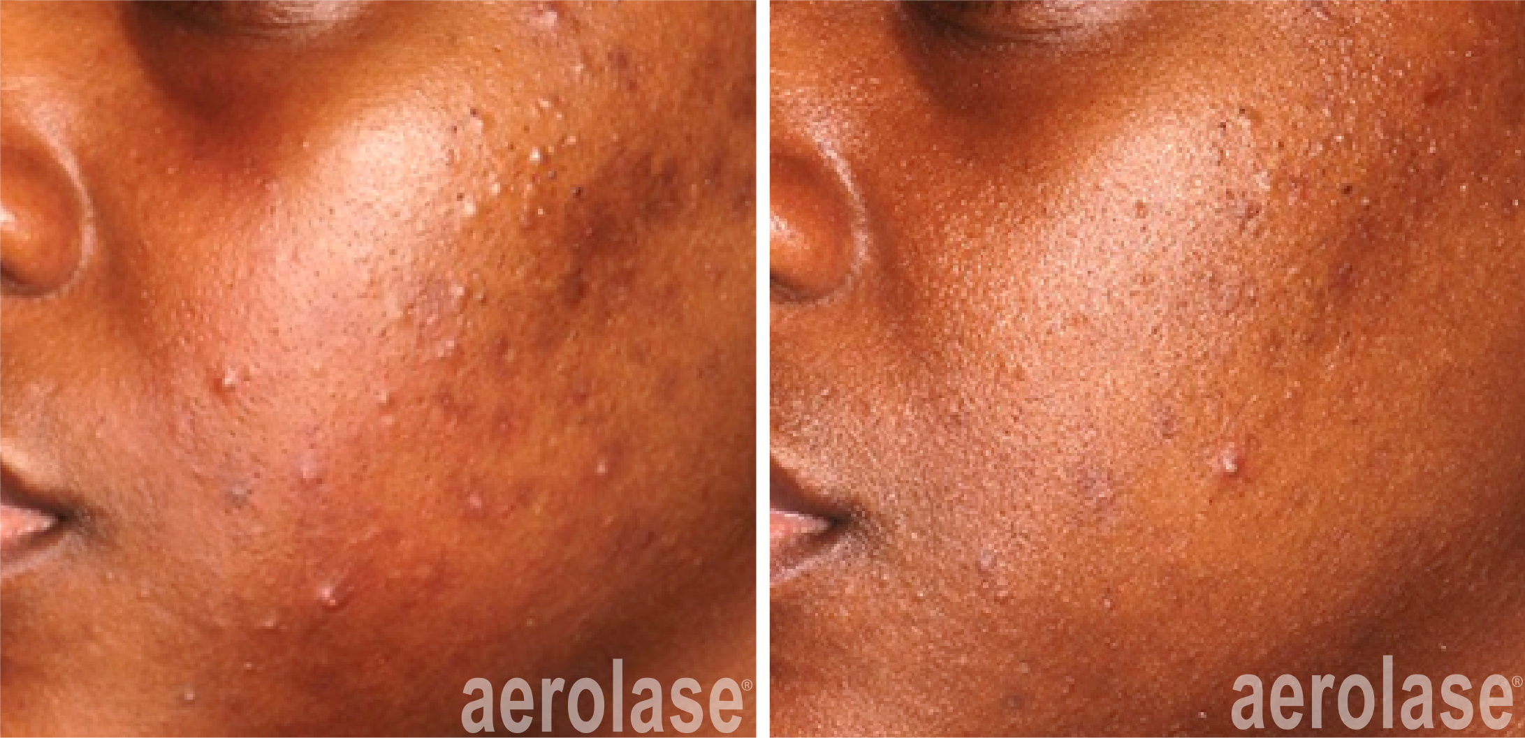 aerolase-before-after-michelle-henry-4-treatments.png