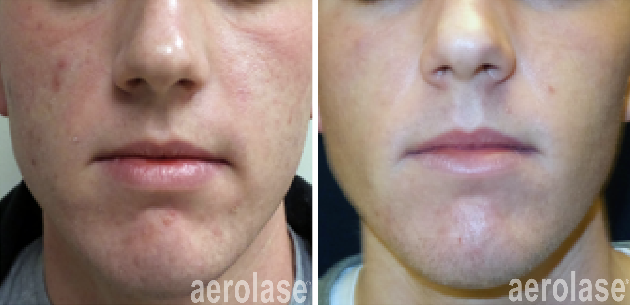 aerolase-kevin-pinski-acne-skin-rejuvenation.png