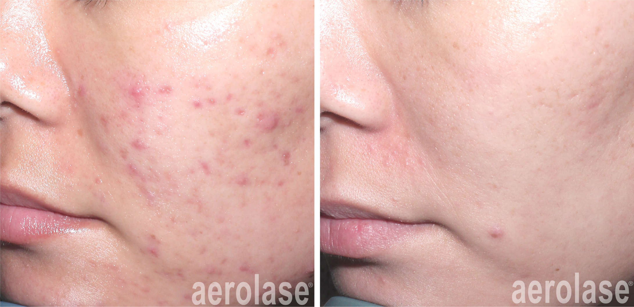 aerolase-acne-spade-before-after-watermark-6-treatments.png