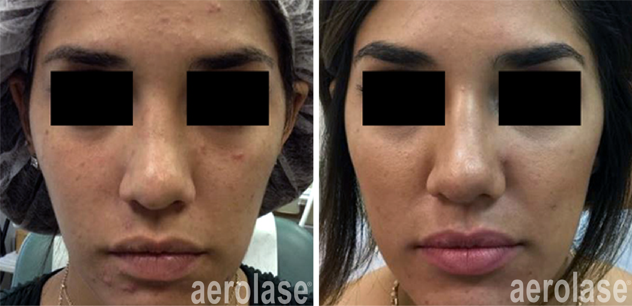 aerolase-mark-nestor-acne-2-months-after-4-treatments.png