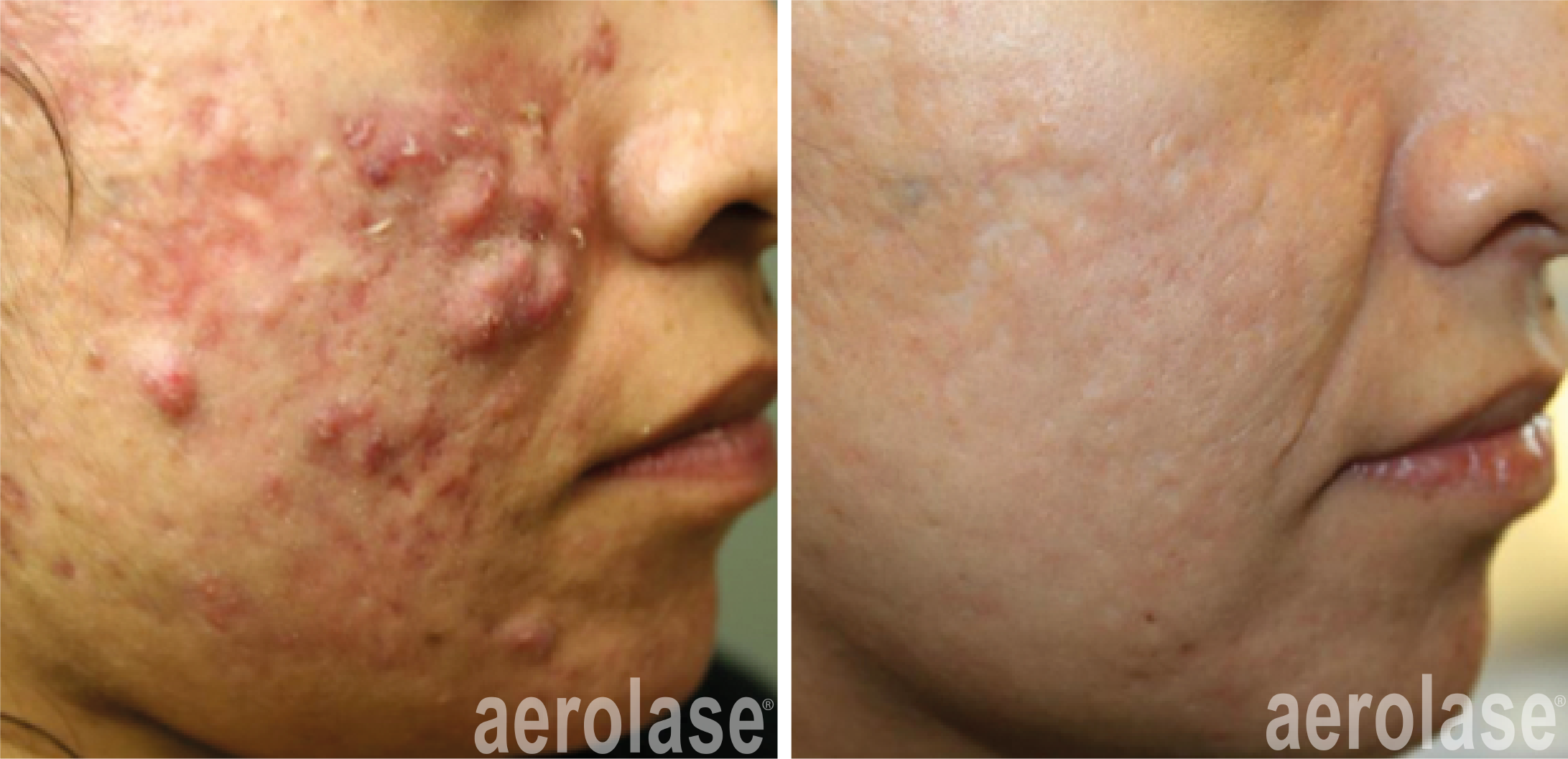 aerolase-michael-gold-acne-5-treatments.png