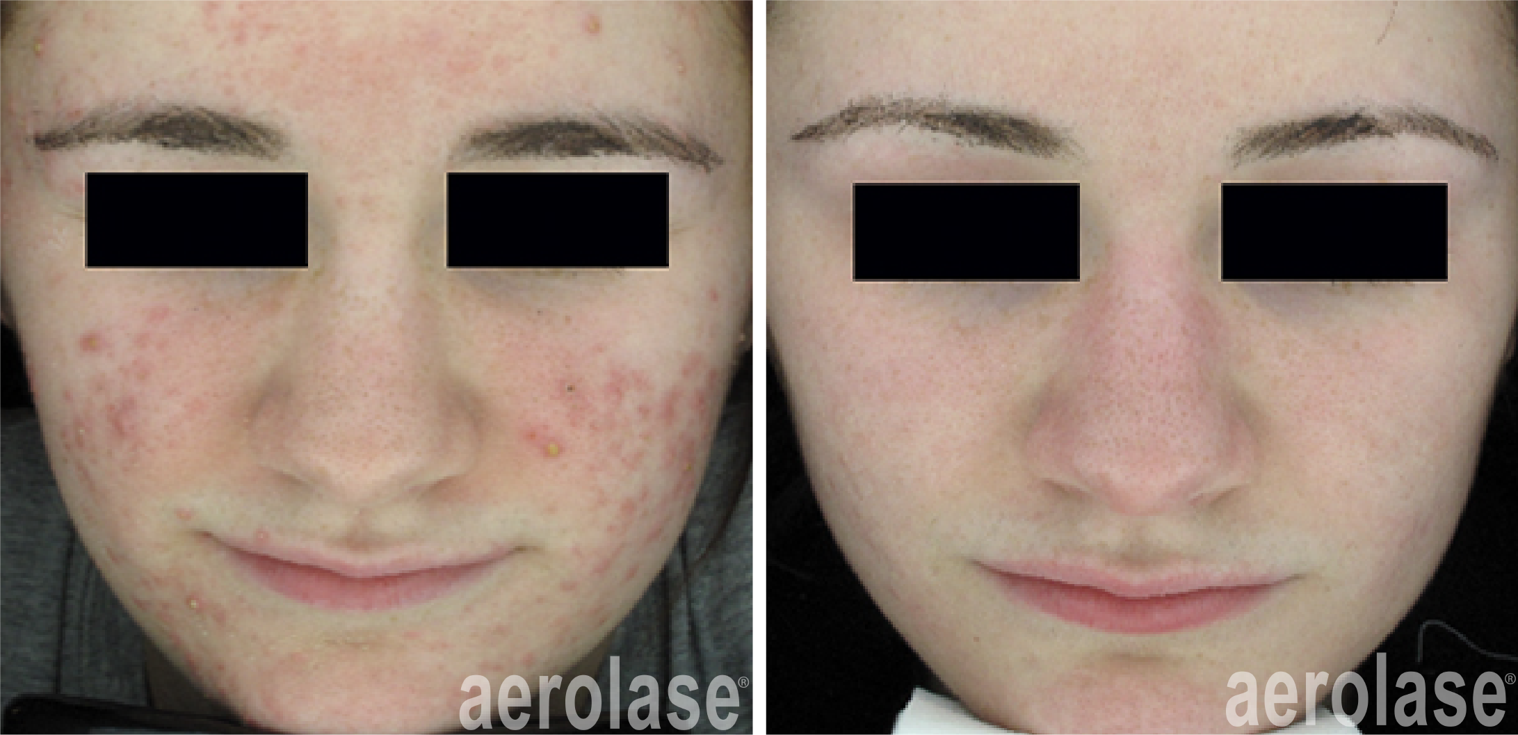 NeoClear Acne - 3 Months After 5 Treatments - David Goldberg MD.png