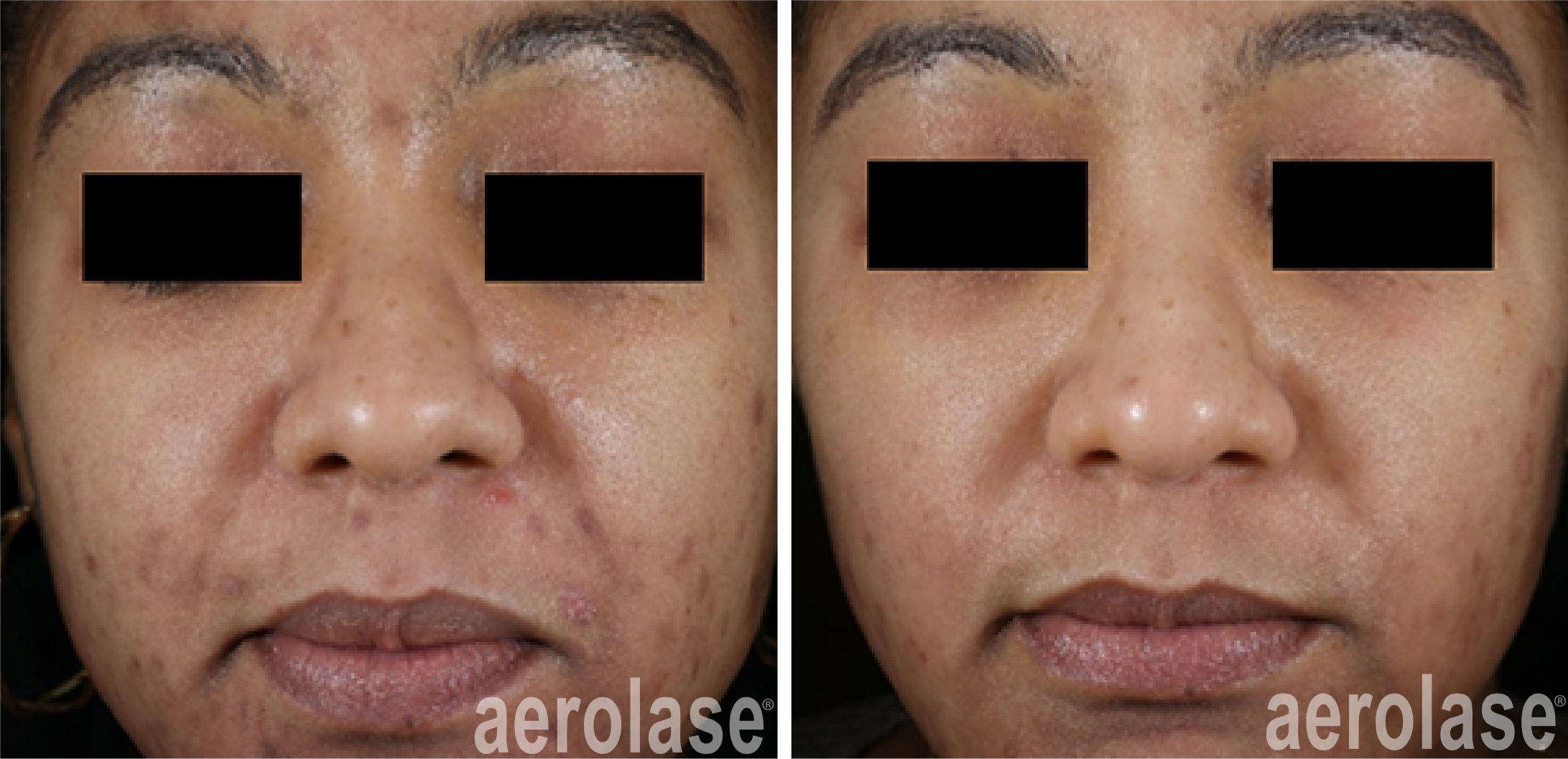 NeoClear Acne - 5 Months After 3 Treatments - David Goldberg MD.png