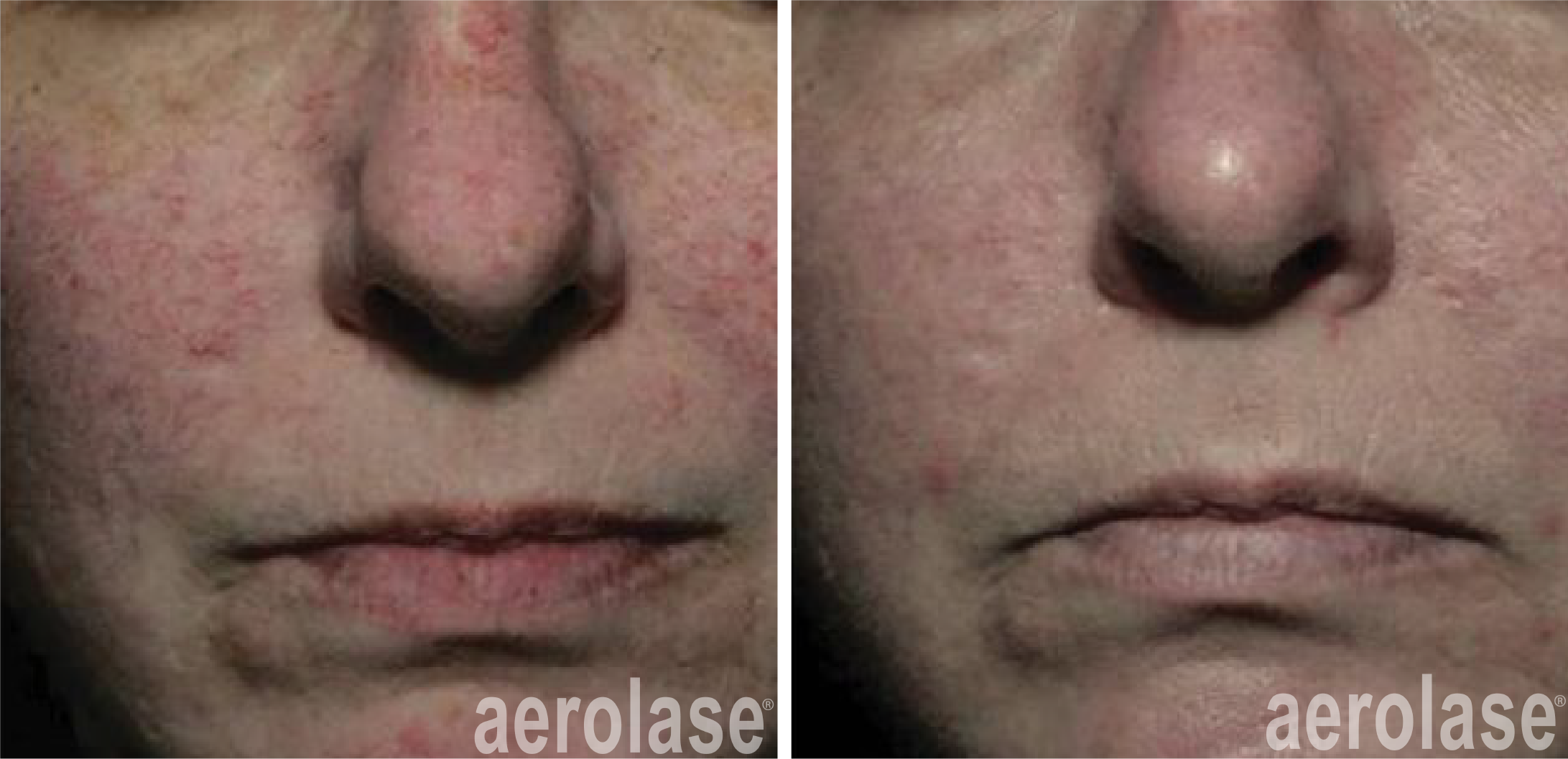 aerolase-NeoSkin Rosacea and Veins - After 2 Treatments - David Goldberg MD.png