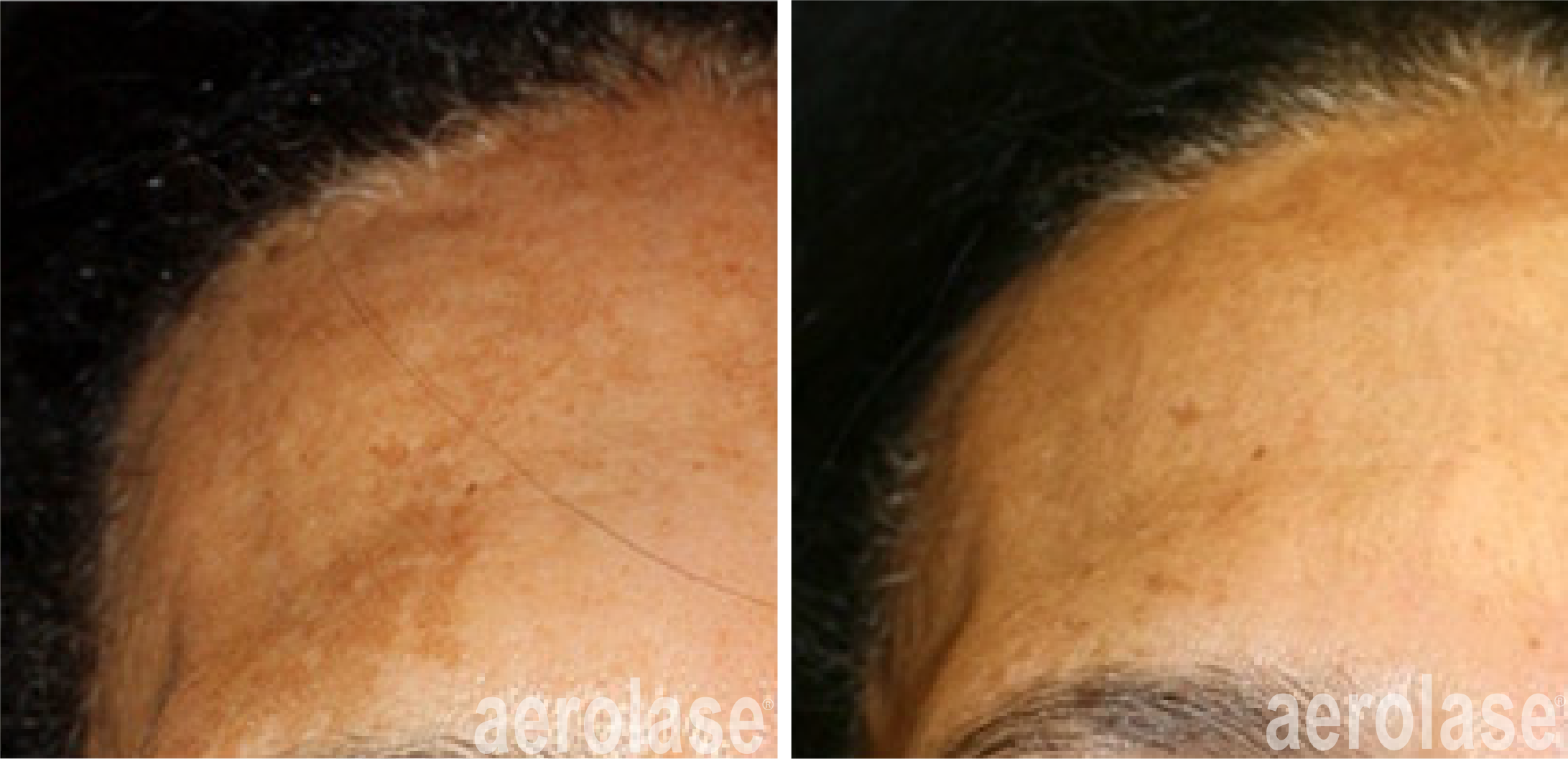 aerolase-neoskin-melasma-after-1-treatment-combined-with-tca-peel-cheryl-burgess.png