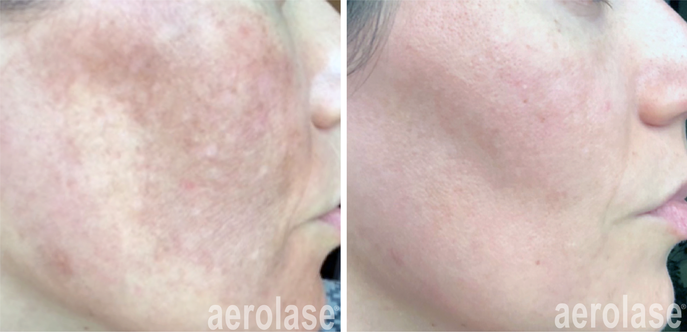 aerolase-neoskin-melasma-Rachel Lowe, LE, Yael Halaas, MD, FACS.png