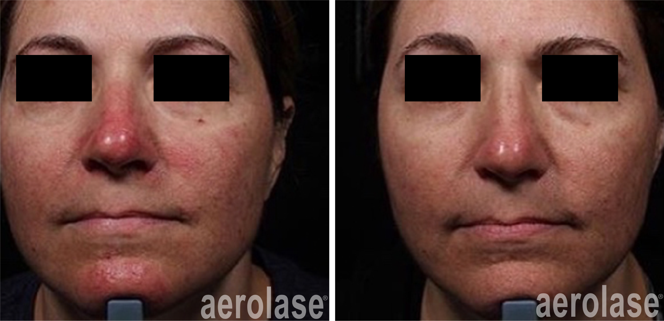 aerolase-neoskin-rosacea-1-week-after-1-treatment-one-aesthetics.png