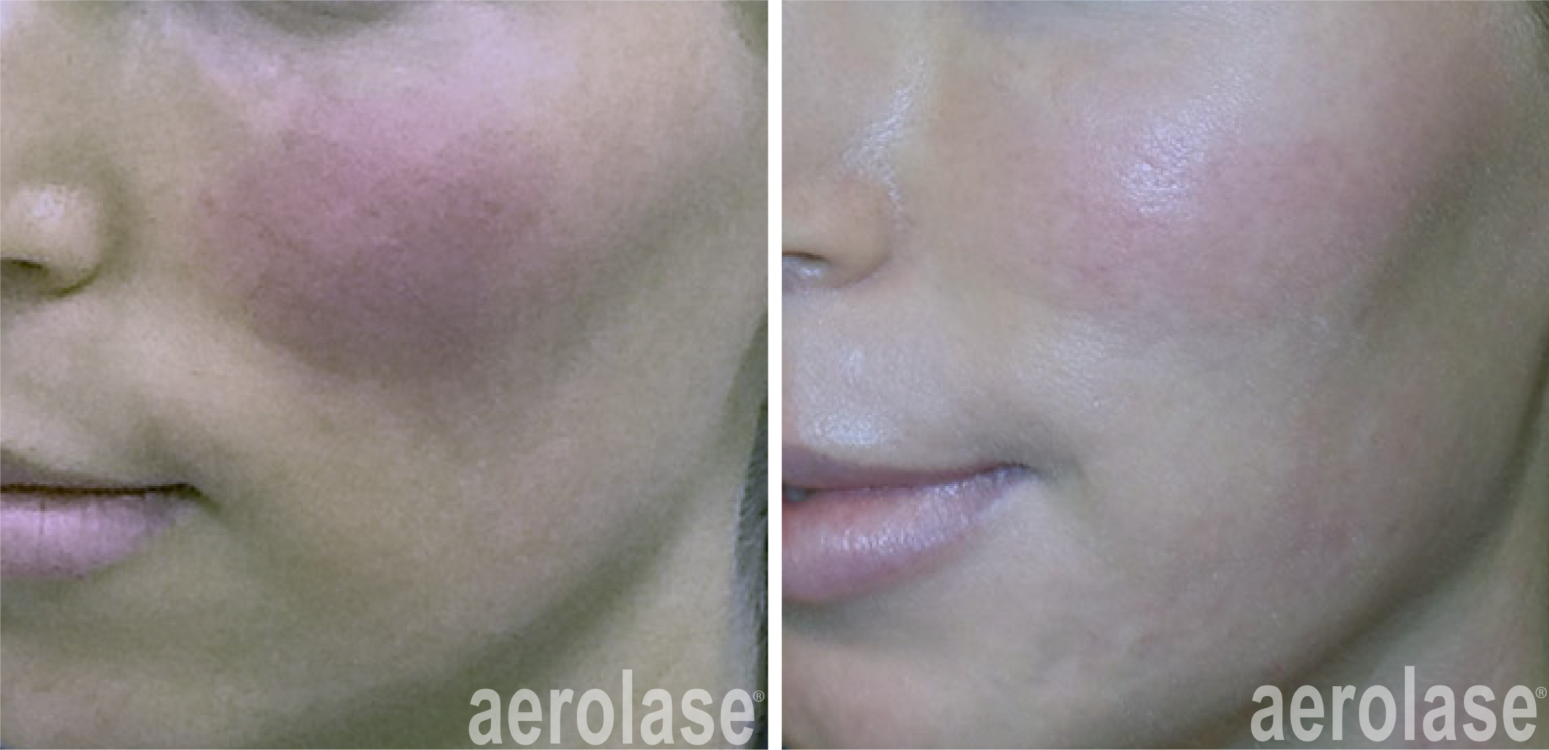 aerolase-neoskin-rosacea-kevin-pinski-after-1-treatment.png