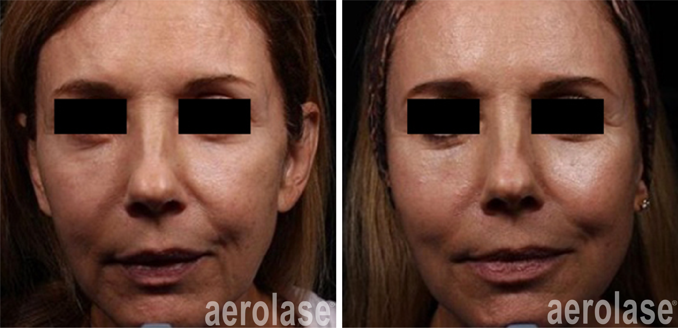 aerolase-neoskin-skin-rejuvenation-after-2-treatments-combined-with-threads-and-filler-one-aesthetics.png