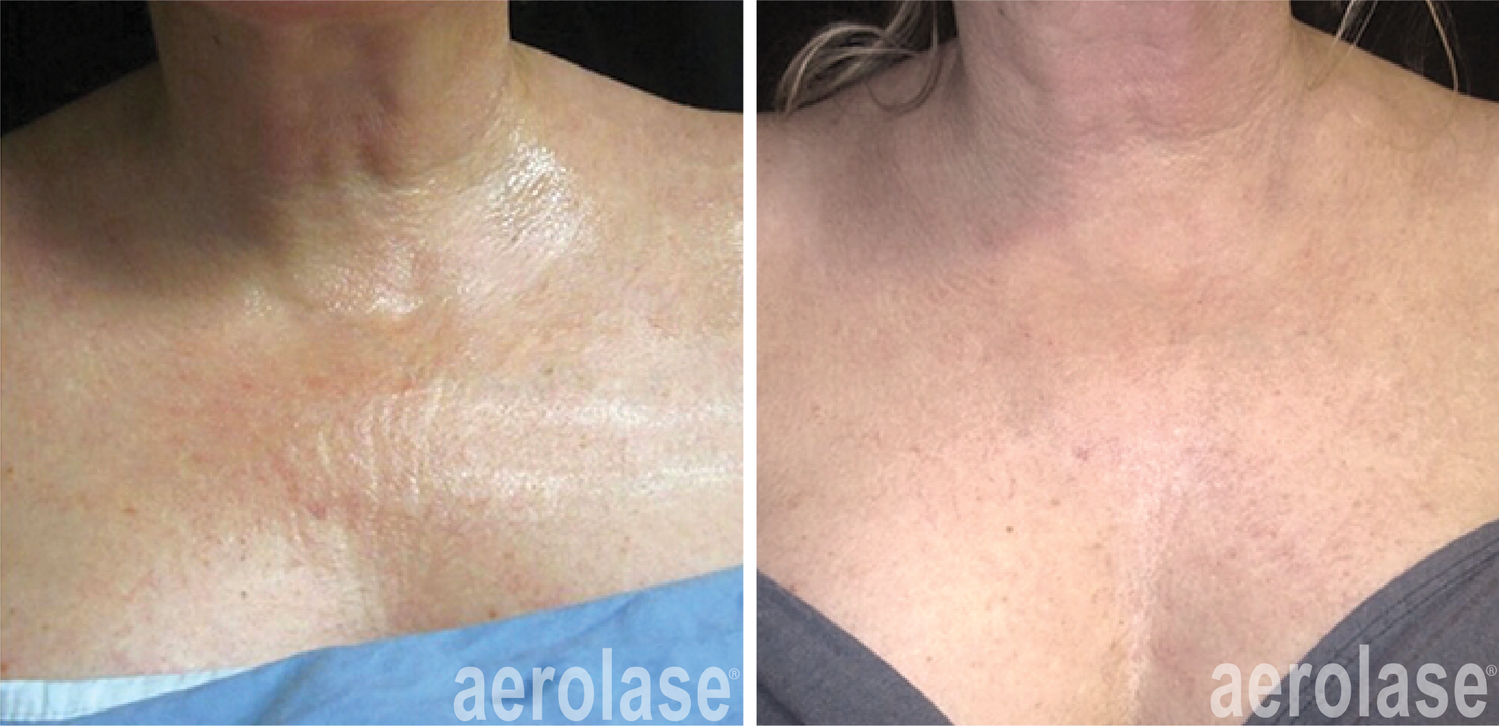 aerolase-neoskin-skin-rejuvenation-after-4-treatments-jason-emer.png