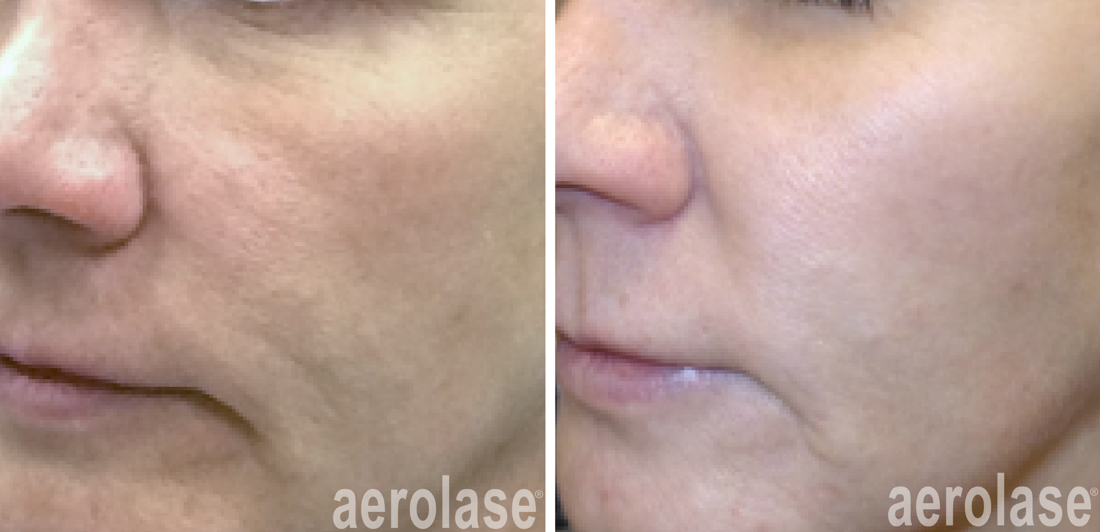 aerolase-skin-rejuvenation-before-after-kevin-pinski-4-treatments.png
