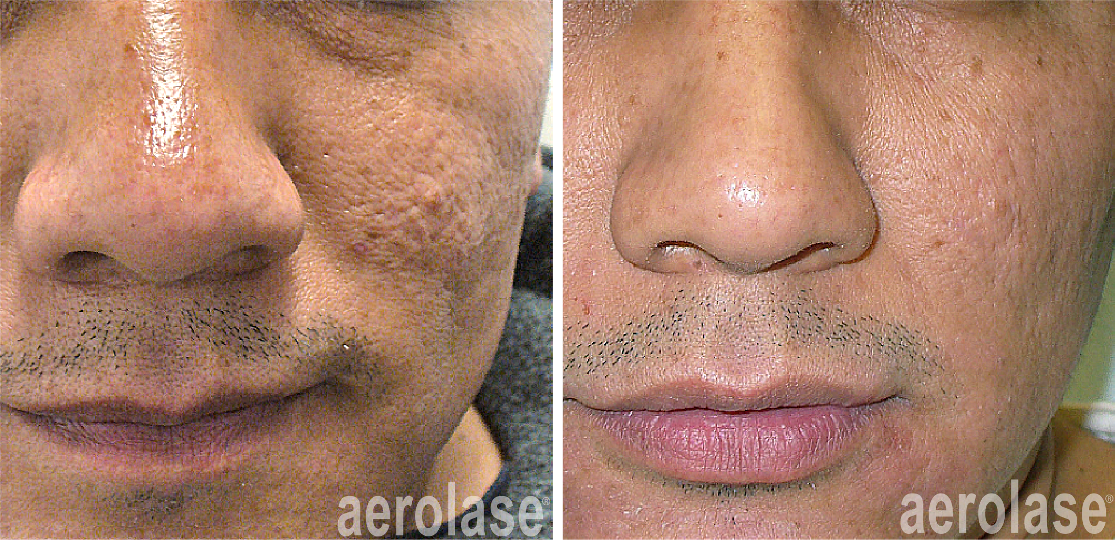 aerolase-skin-rejuvenation-fran cook bolden-after-7-treatments.png