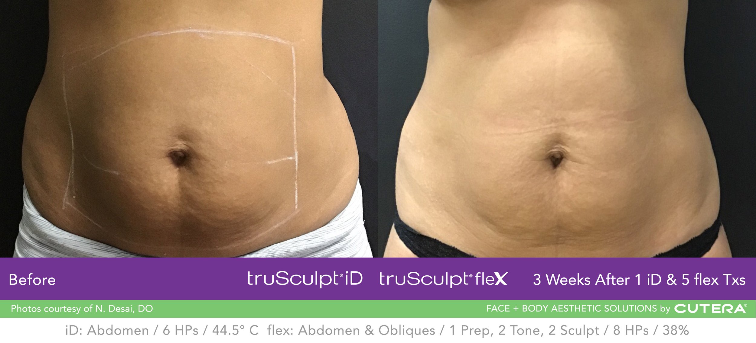 truSculpt-iD-flex-Combo-B-A-Desai-A.jpg