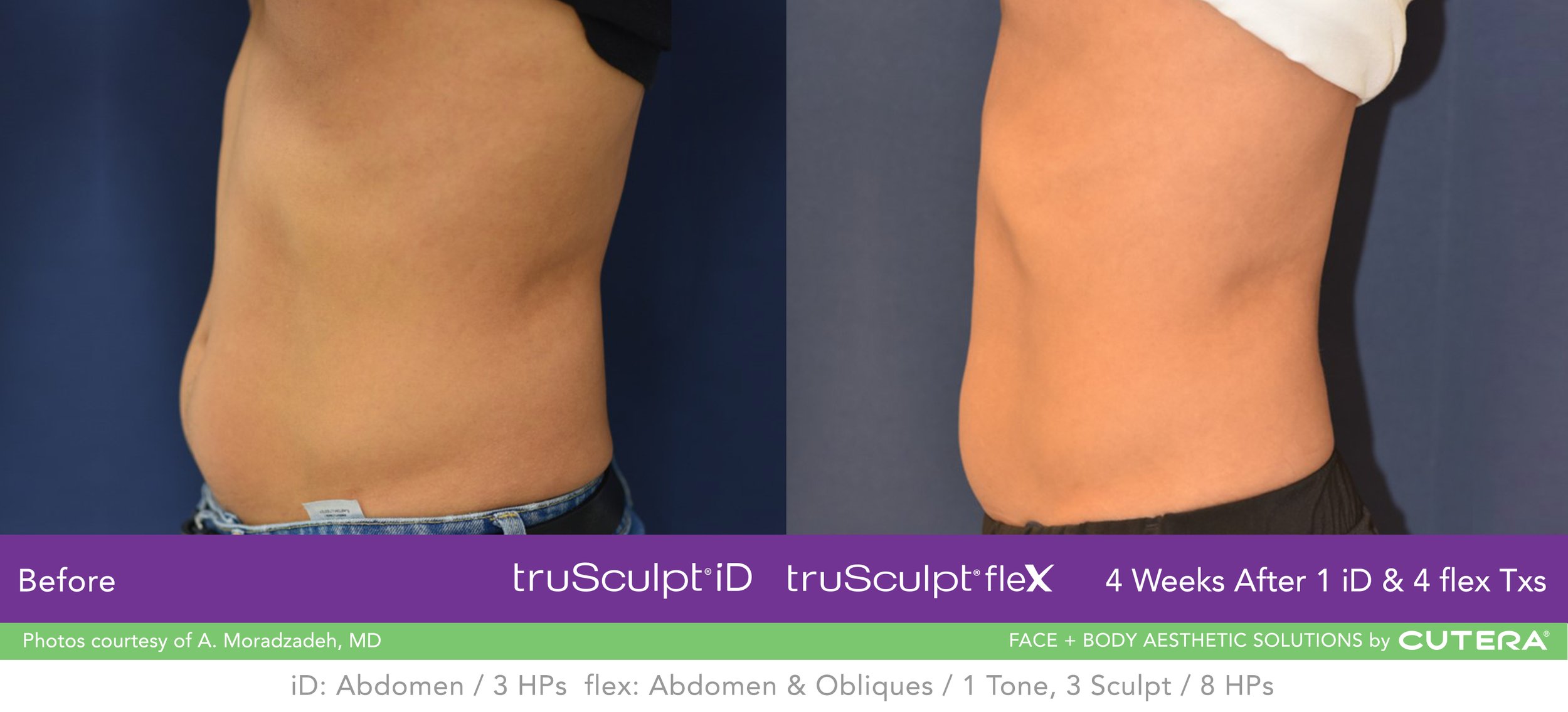 truSculpt-iD-flex-Combo-B-A-Moradzadeh-A.jpg