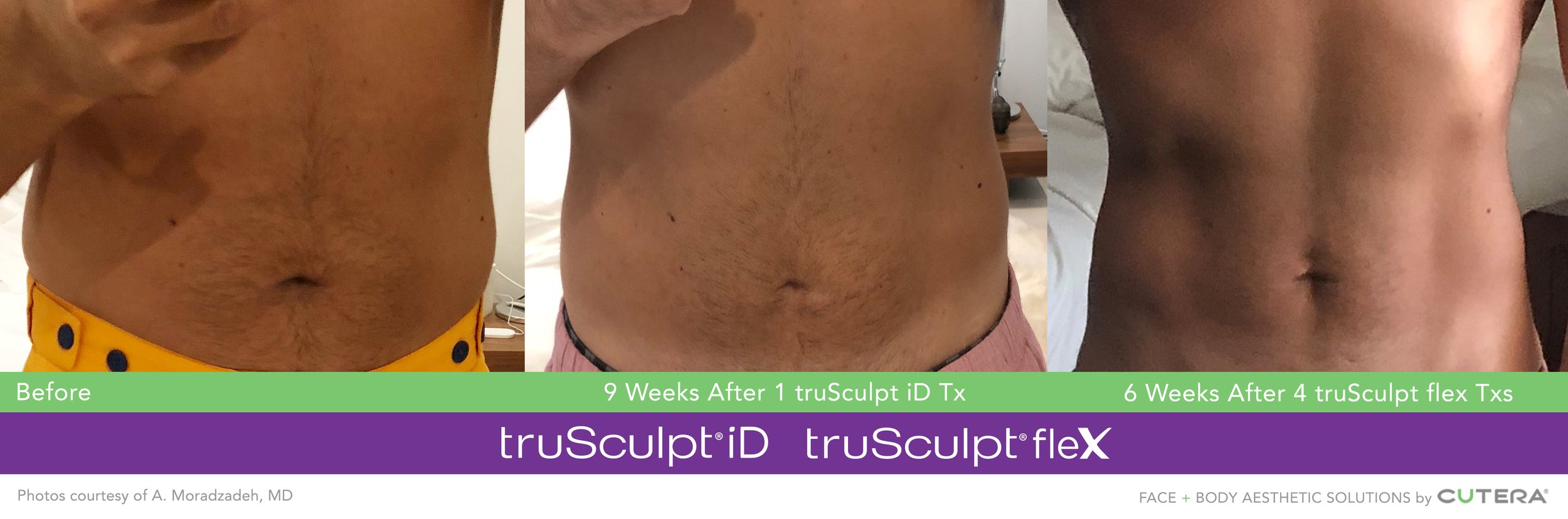 truSculpt-iD-flex-Moradzadeh-6-9Weeks-(3).jpg