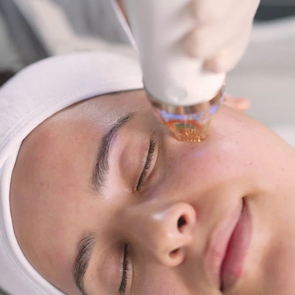 Mesoneedling Treatment — ici paris skin clinic + spa