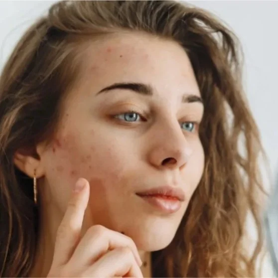 Why your skin might worsen in the spring and how to manage it