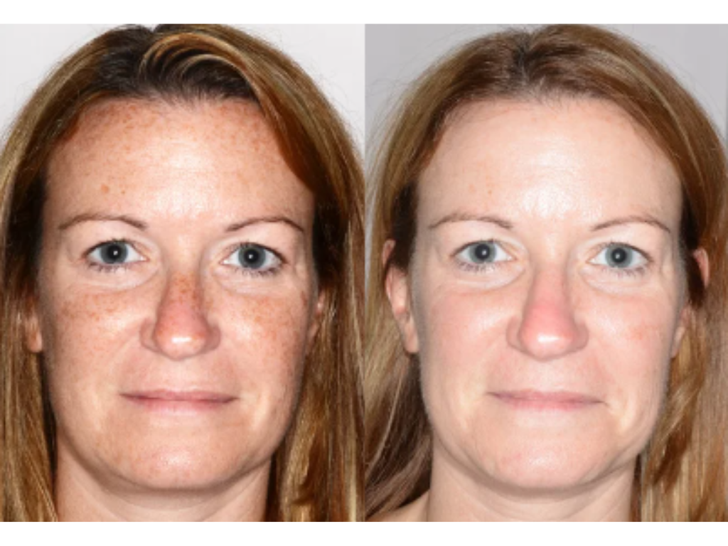 Ipl Technology Intense Pulsed Light (IPL) Treatment — ici paris skin clinic + spa