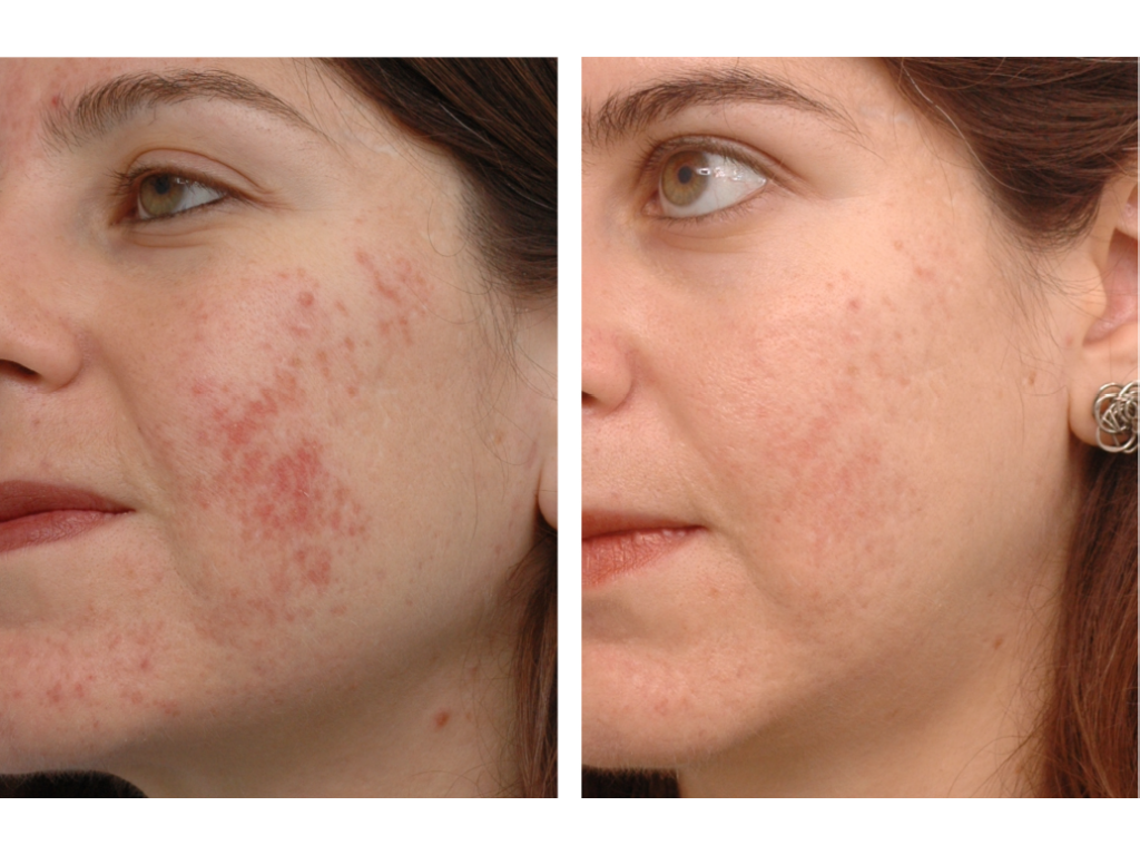 Ipl Rash Intense Pulsed Light (IPL) Treatment — ici paris skin clinic + spa