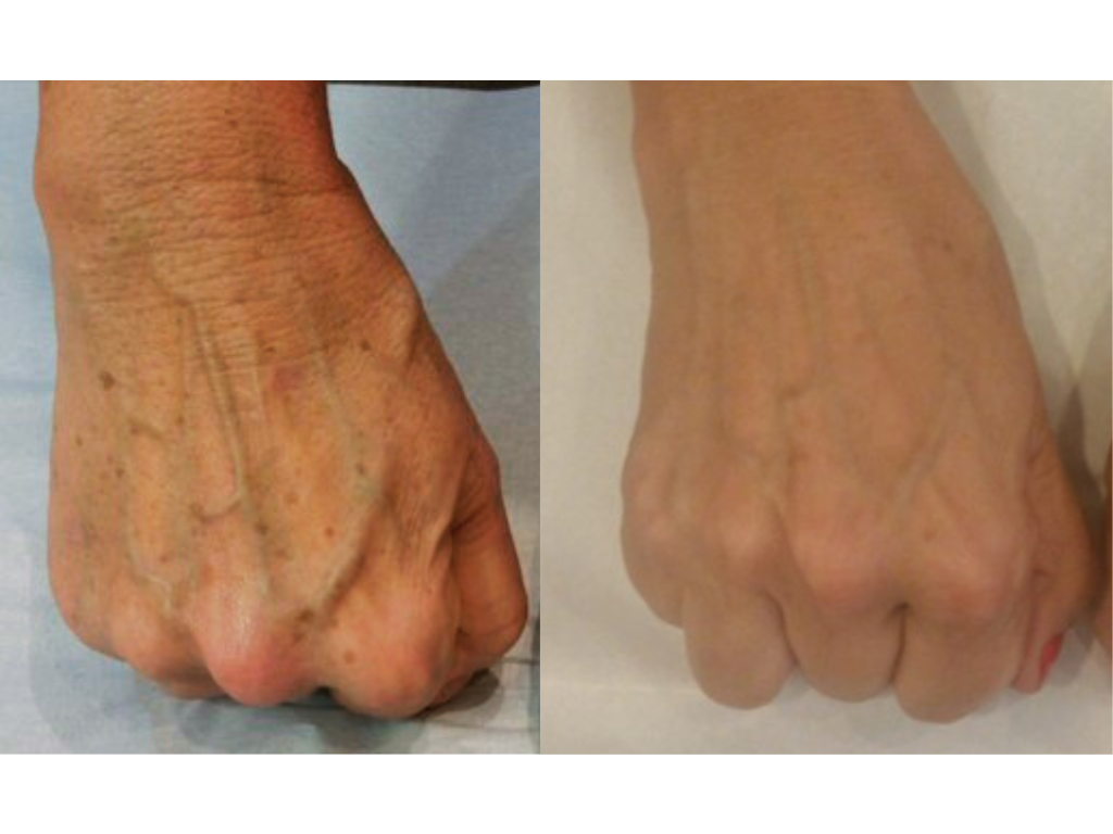 Ipl Rash Intense Pulsed Light (IPL) Treatment — ici paris skin clinic + spa