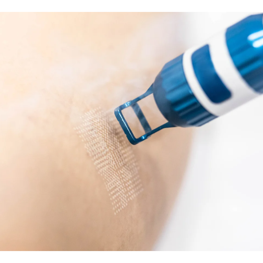 Pixel Laser Resurfacing