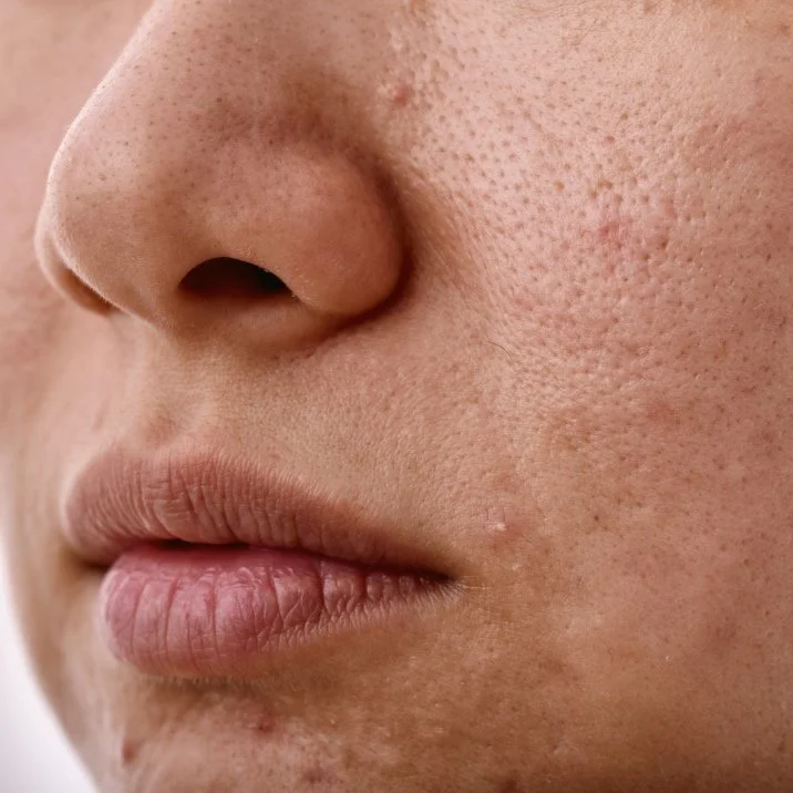 How to get rid of textured skin + even out your tone?