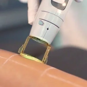 No More Shaving: Embrace Freedom with Laser Hair Removal