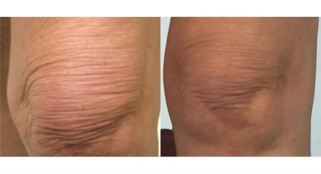 RF+Skin+Tightening+%281%29.jpg