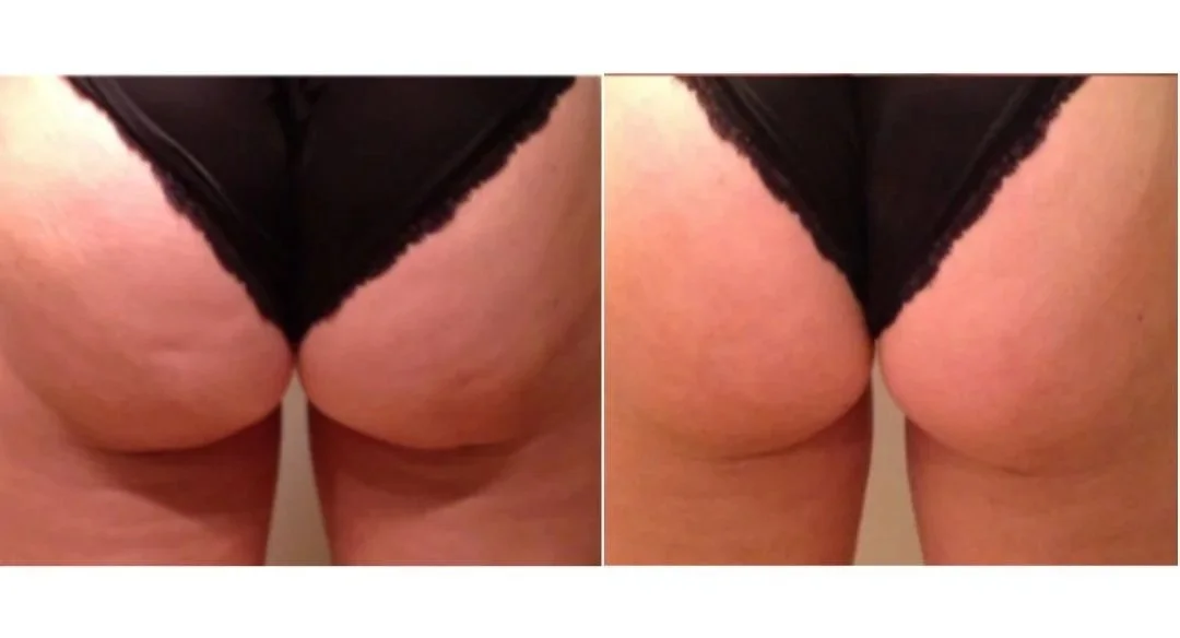 RF+Skin+Tightening.jpg