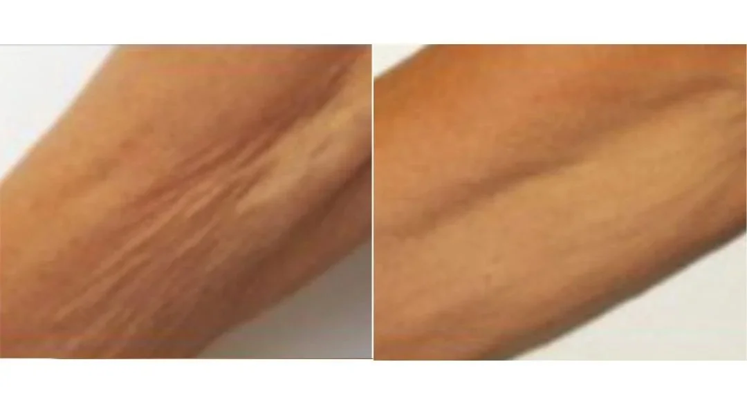 RF+Skin+Tightening+%282%29.jpg