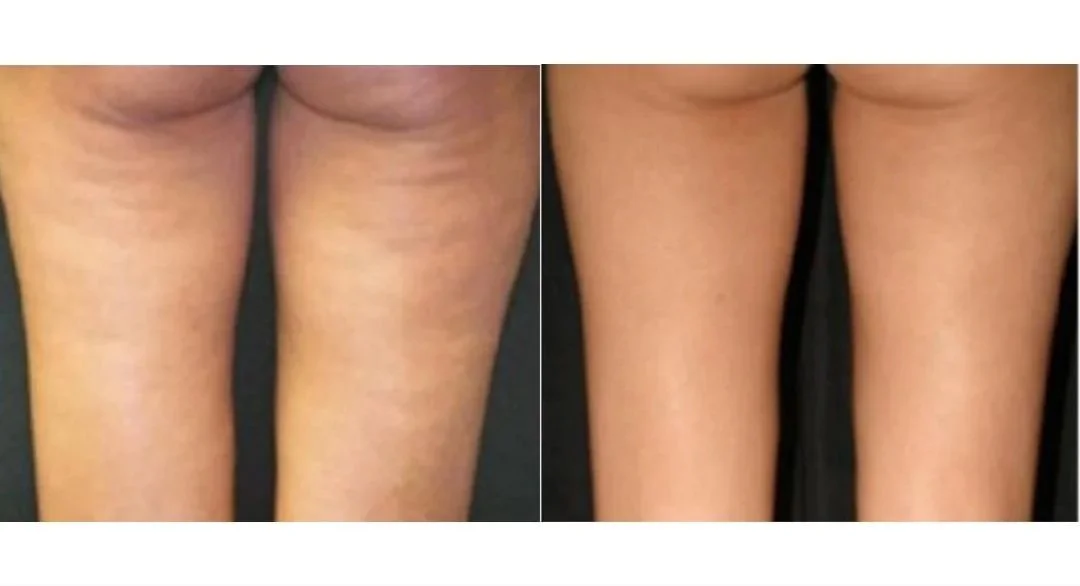 RF+Skin+Tightening+%283%29.jpg