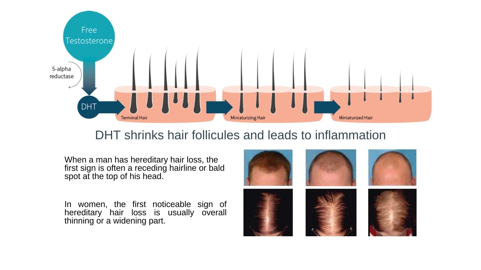 FTM hair loss