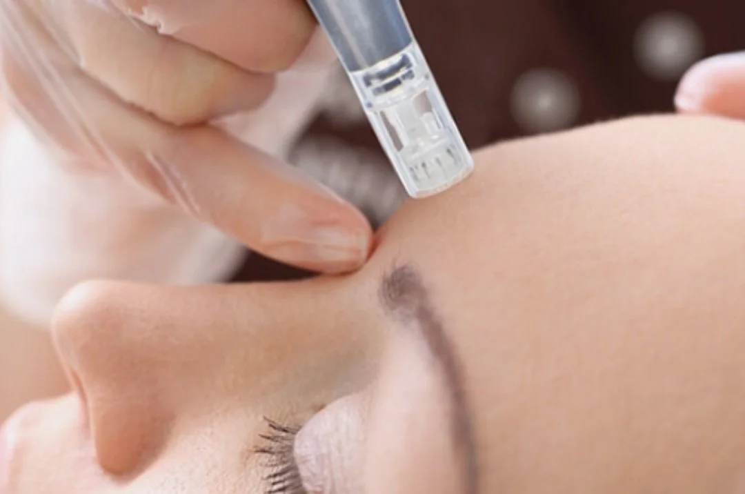 Microneedling / Microchanneling