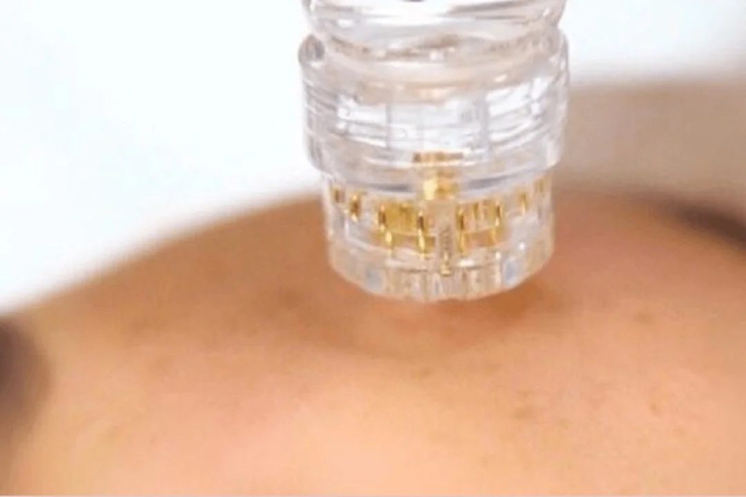 Mesoneedling Treatment