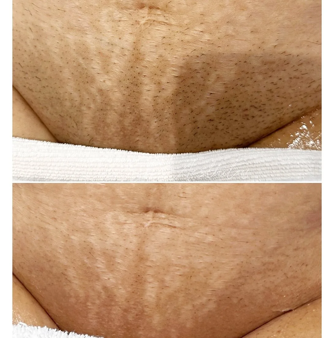 Its laser season ⚡️ 

Laser Hair Removal 
⏰ Downtime: NONE
🔍 Sessions (for effective results): 8-14 sessions
📆 Bookings: 6-8 weeks (for body) 4-6 weeks (for face) apart Appointments 
❌ Contraindications: no blood thinners, antibiotics, Advil, pregn