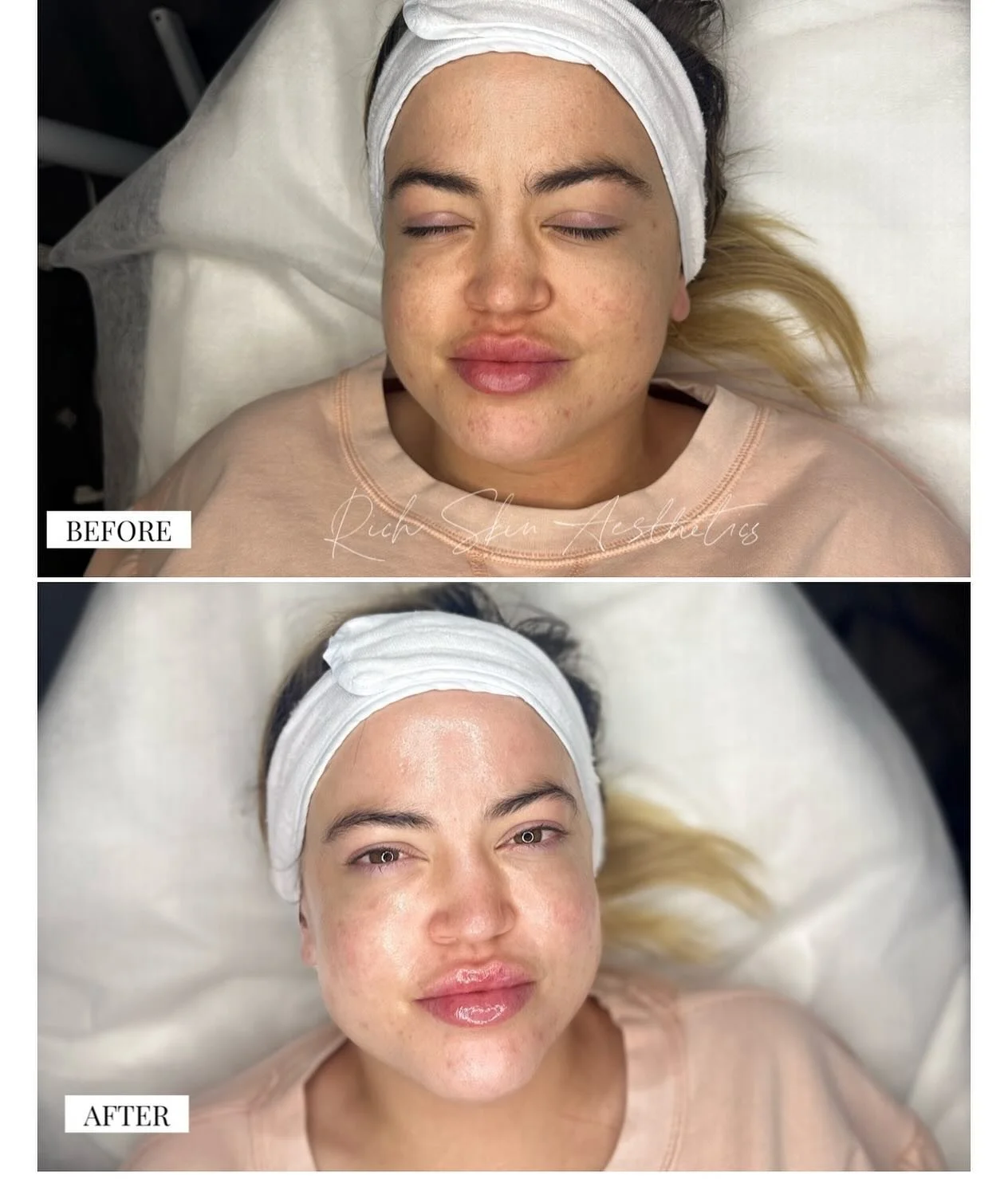 From dehydrated skin to hydrated glow 💫 
We did hydrafacial + dermaplaning + LA Spa Glycolic Peel.

🗓️ 𝗕𝗢𝗢𝗞 𝗔 FREE 𝗖𝗢𝗡𝗦𝗨𝗟𝗧𝗔𝗧𝗜𝗢𝗡

Hi there! New to Rich Skin Aesthetics? Book your FREE consultation to discover the perfect treatment f