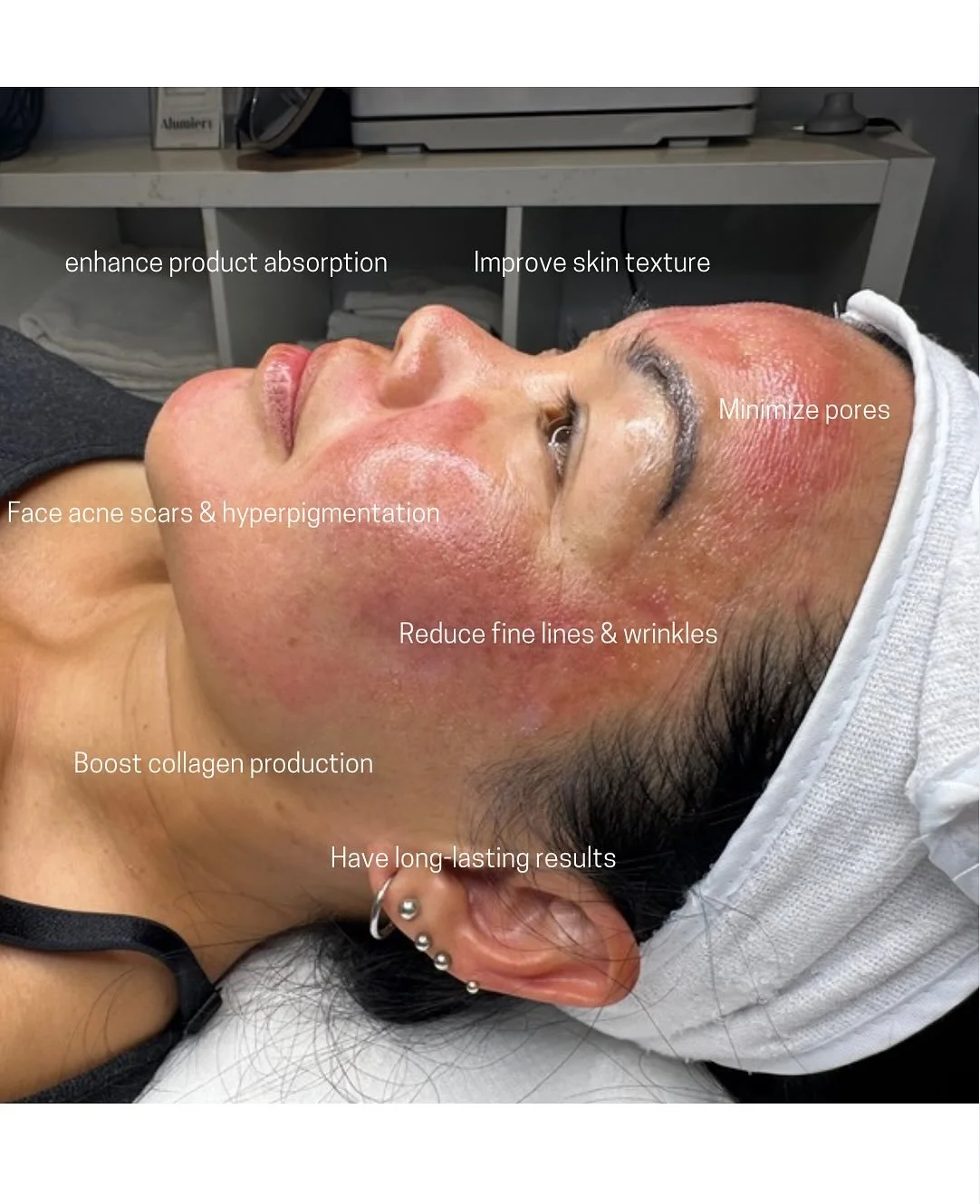 treating pigmentation and aging isn&rsquo;t just about one treatment it&rsquo;s about a consistent, customized plan designed for your skin.

✨ Brighter. Firmer. More confident.
That&rsquo;s the power of microneedling + medical-grade skincare.

🗓️ 𝗕