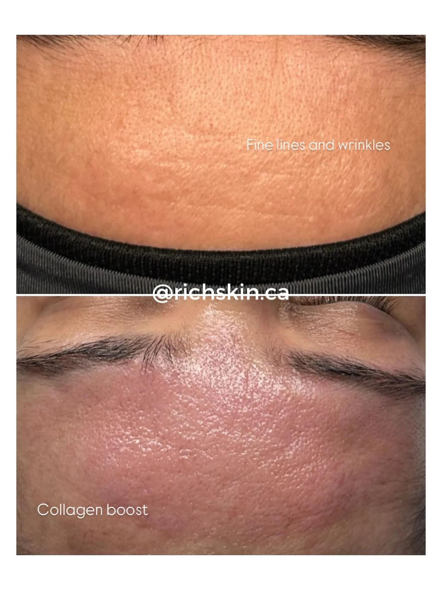 Let&rsquo;s talk about aging skin.

As we get older, our skin naturally slows down its collagen and elastin production &mdash; the two key proteins that keep our skin firm, smooth, and youthful.

Over time, this leads to:
🔹 Fine lines &amp; wrinkles