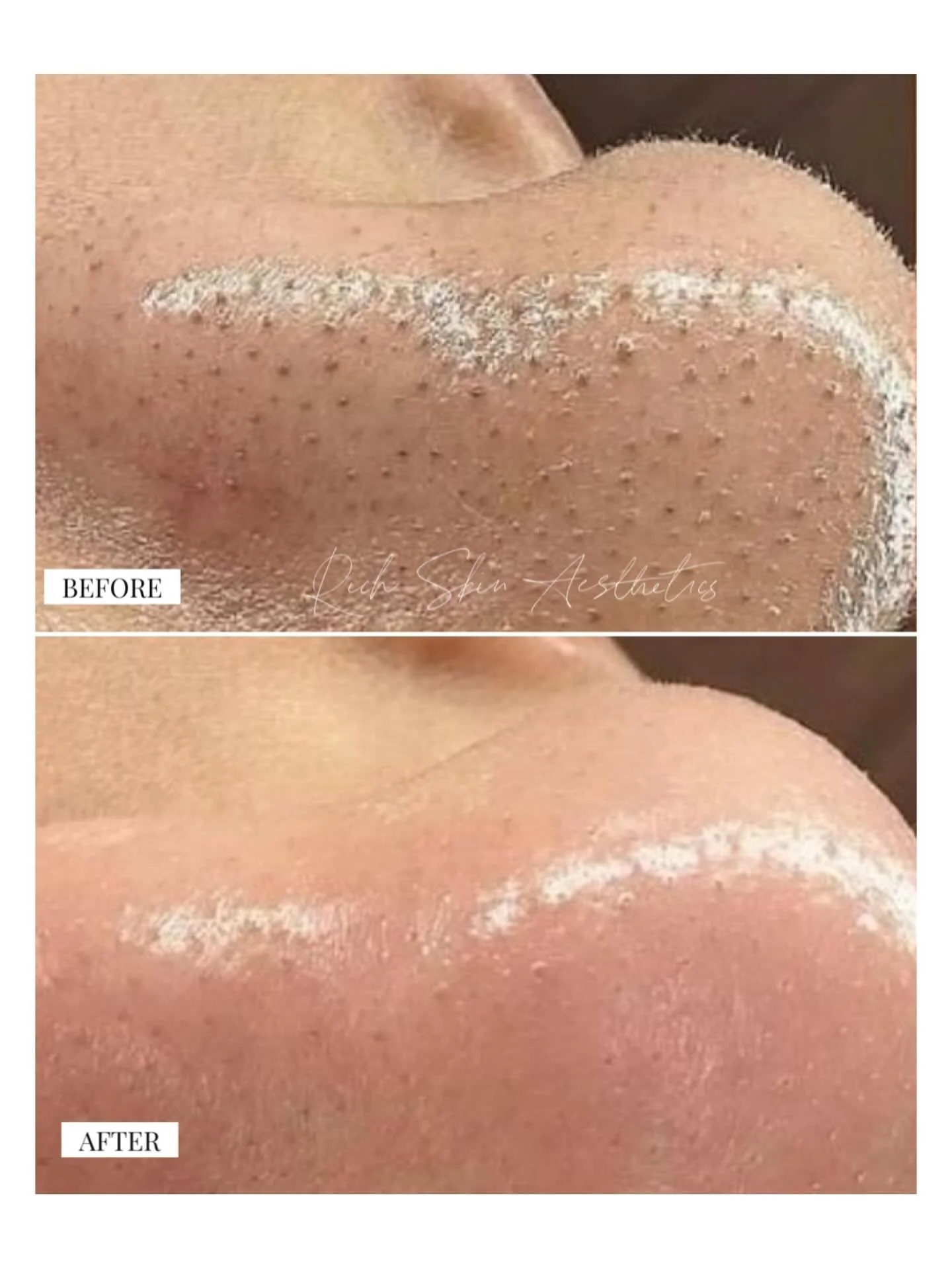 Extractions = key to clear skin success! 

Ever wonder why your esthetician takes time to do extractions during your facial? Here&rsquo;s why they&rsquo;re so important 👇

💧 1. Clears Congested Pores
Blackheads are clogged pores filled with oil and