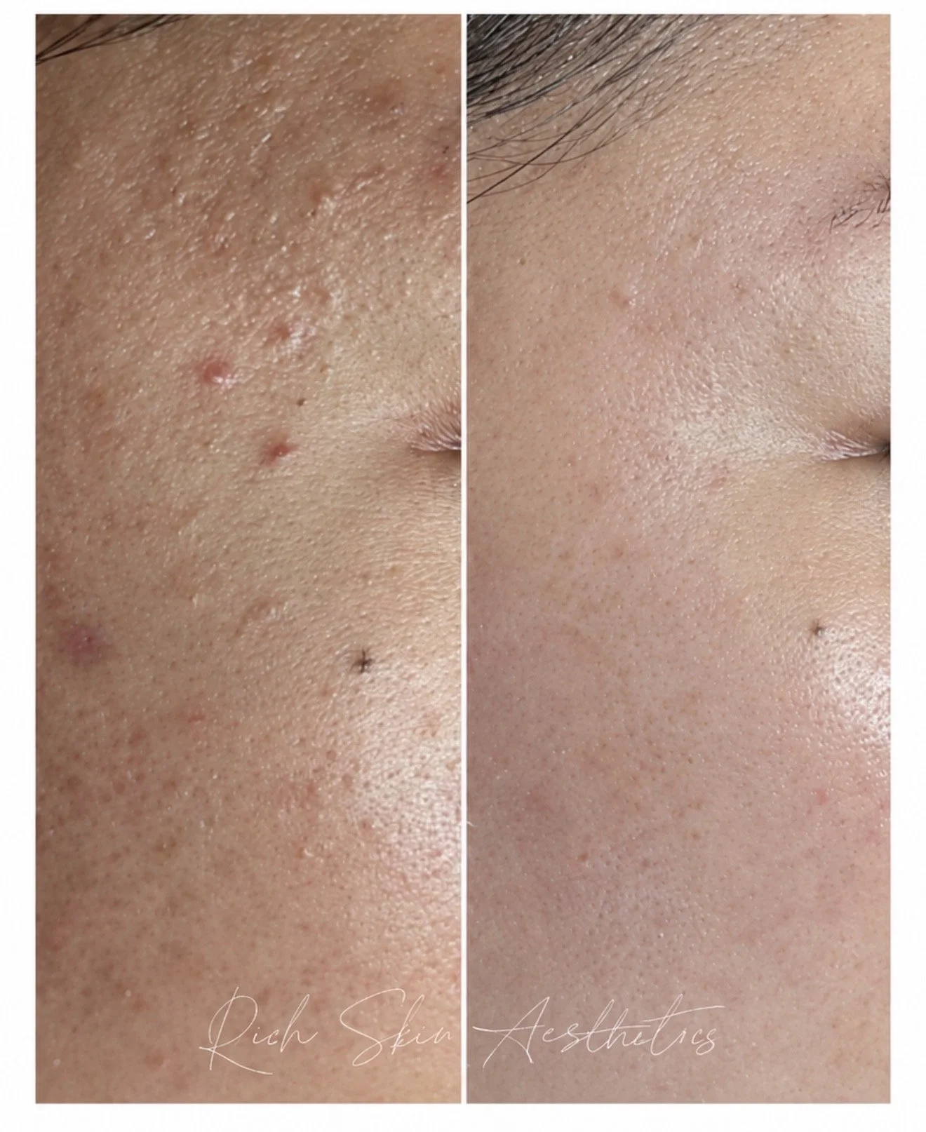Before and after acne treatment results at Rich Skin Aesthetics Markham