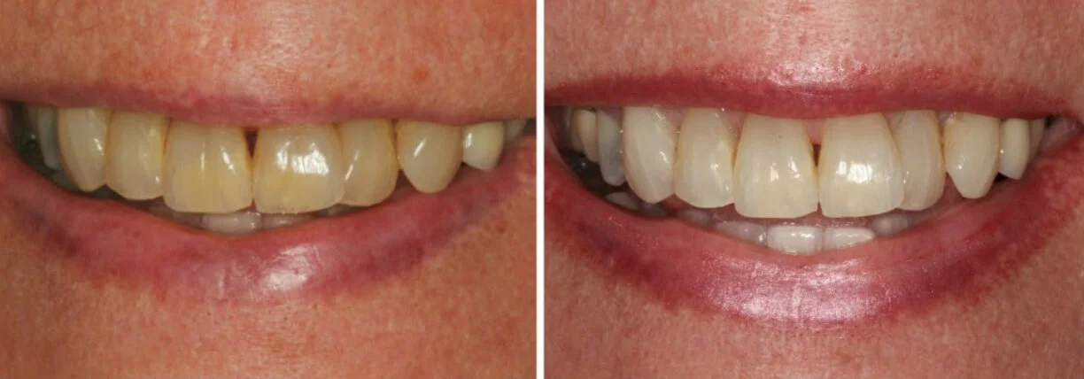 Teeth Whitening — Dentistry By Design