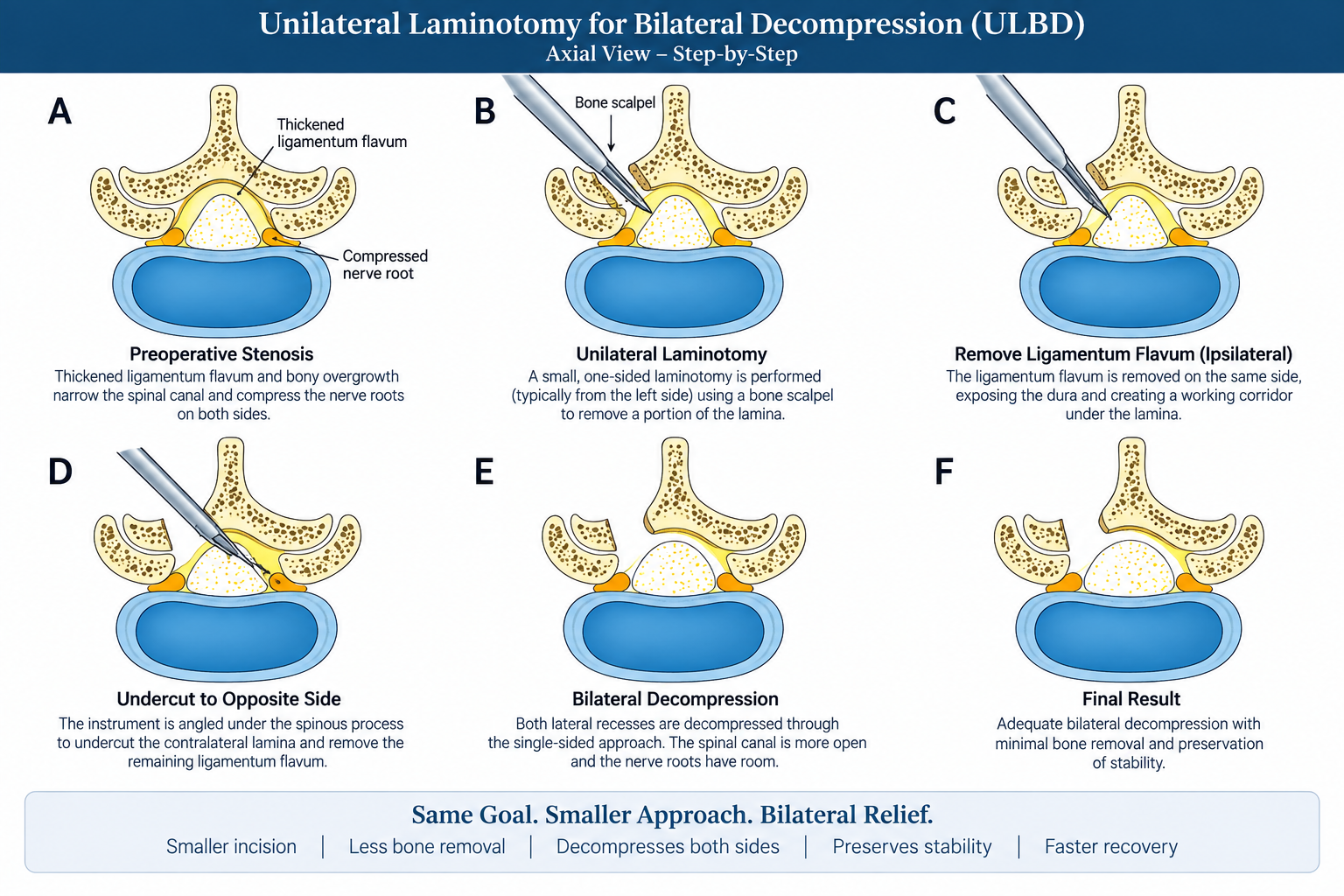 Diagram illustrating step-by-step procedure for unilateral laminotomy for bilateral decompression (ULBD), showing stages from preoperative stenosis, performing laminotomy, removing ligamentum flavum, undercutting to opposite side, bilateral decompression, and final result with minimal bone removal.