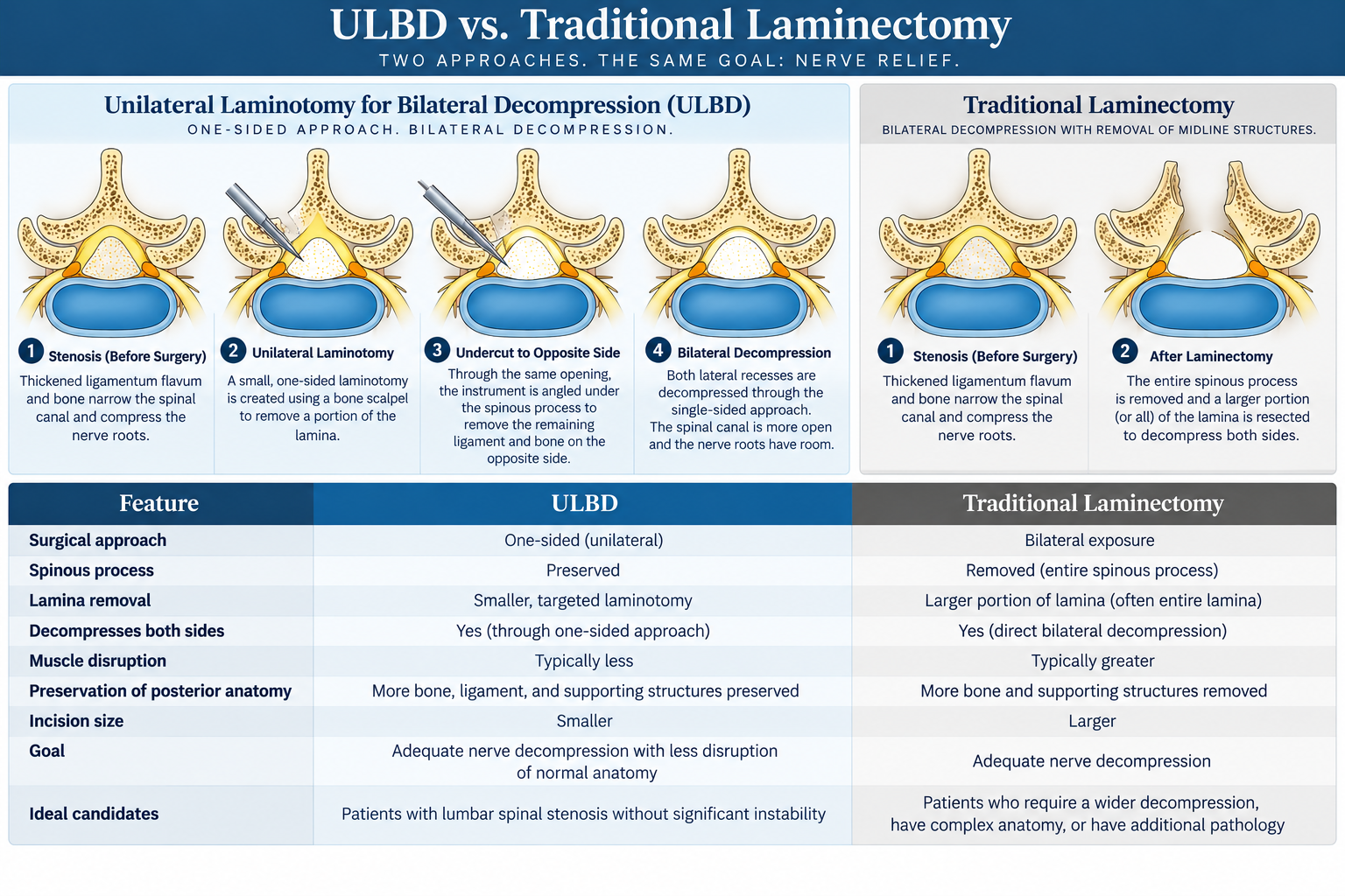 Comparison chart of ULBD versus traditional laminectomy for nerve relief. The ULBD side shows the steps of unilateral laminotomy, including stenosis, laminotomy, undercut to opposite side, and bilateral decompression, with features like preserved spinous process and smaller incision. The traditional laminectomy side illustrates bilateral decompression with removed spinous process, larger incision, and more bone removal.