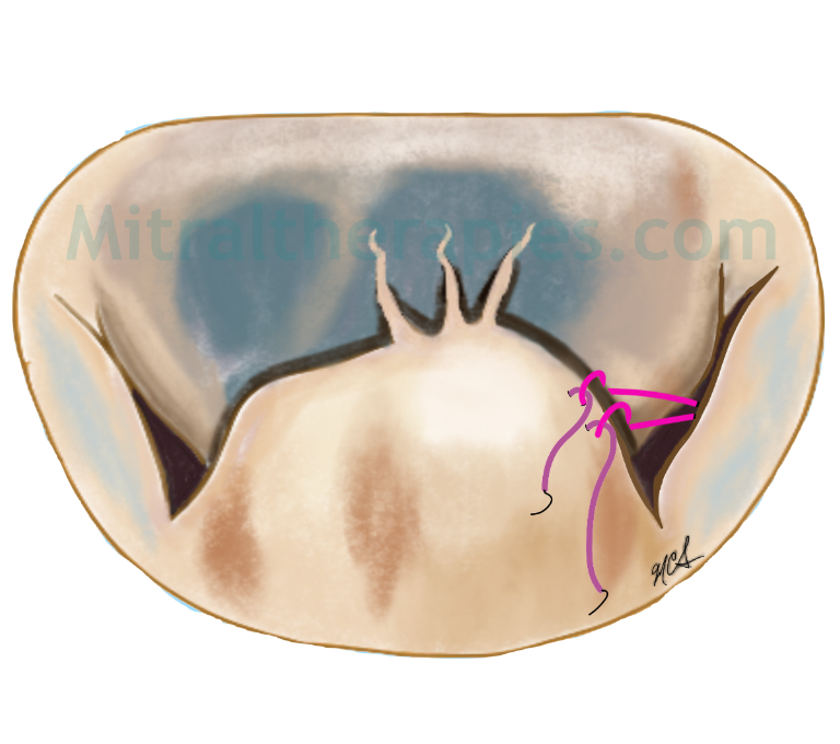 Management of the P2 flail/prolapse