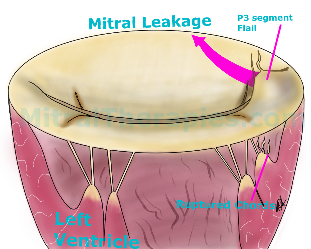 Commissural Leaflet Flail/Prolapase