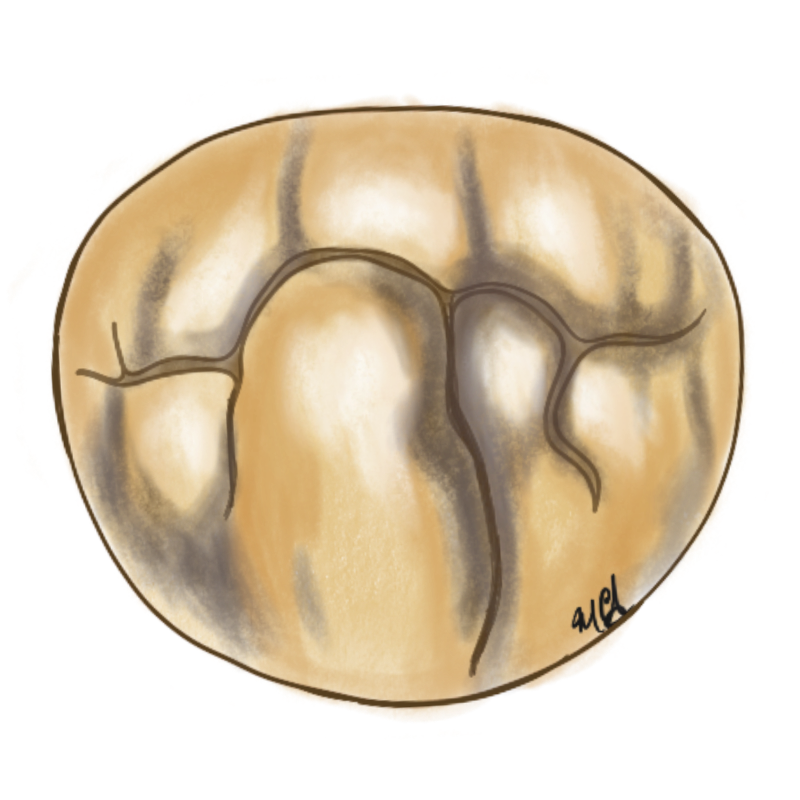 Management of the Myxomatous Valve
