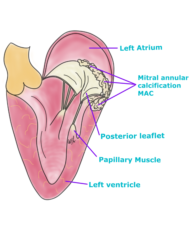 Management of Mitral Annular Calcification